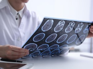 Epilepsia farmacorresistente: la pista de una terapia no invasiva por