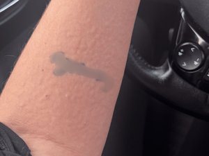 "Pareciera que tengo pulgas": Julie vive con urticaria aquagénique y