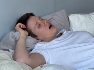 Apneas del sueño: la estimulación del nervio hipogloso efectiva por