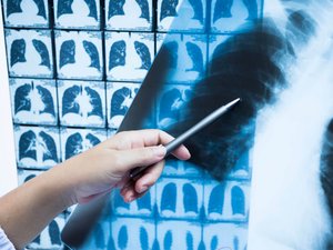 Cáncer de pulmón: la inmunoterapia antes de la cirugía confirma