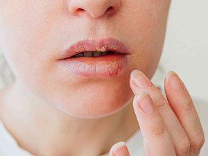 Herpes labial: 10 cosas que debes saber sobre el bouton