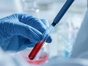 Un análisis de sangre promete predecir el riesgo de demencia