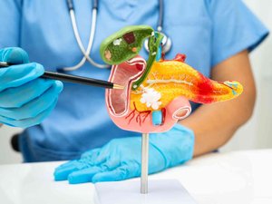 Cáncer de páncreas: un nuevo medicamento duplica la supervivencia a