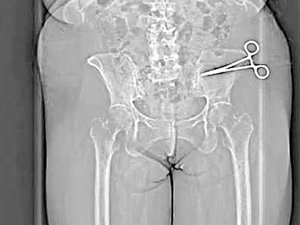 Des tijeras de 15 centímetros olvidadas en su abdomen tras