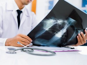 Detección del cáncer de pulmón: inicio de la fase de