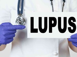 Lupus: 6 cosas que debes saber sobre esta enfermedad autoinmune