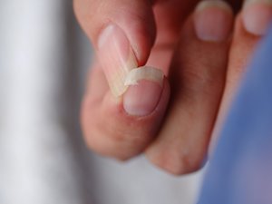 Uñas quebradizas: ¿cuáles son las causas? ¿Cómo tratarlas?