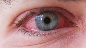 Un œil avec une pupille bleue et une conjonctive enflammée