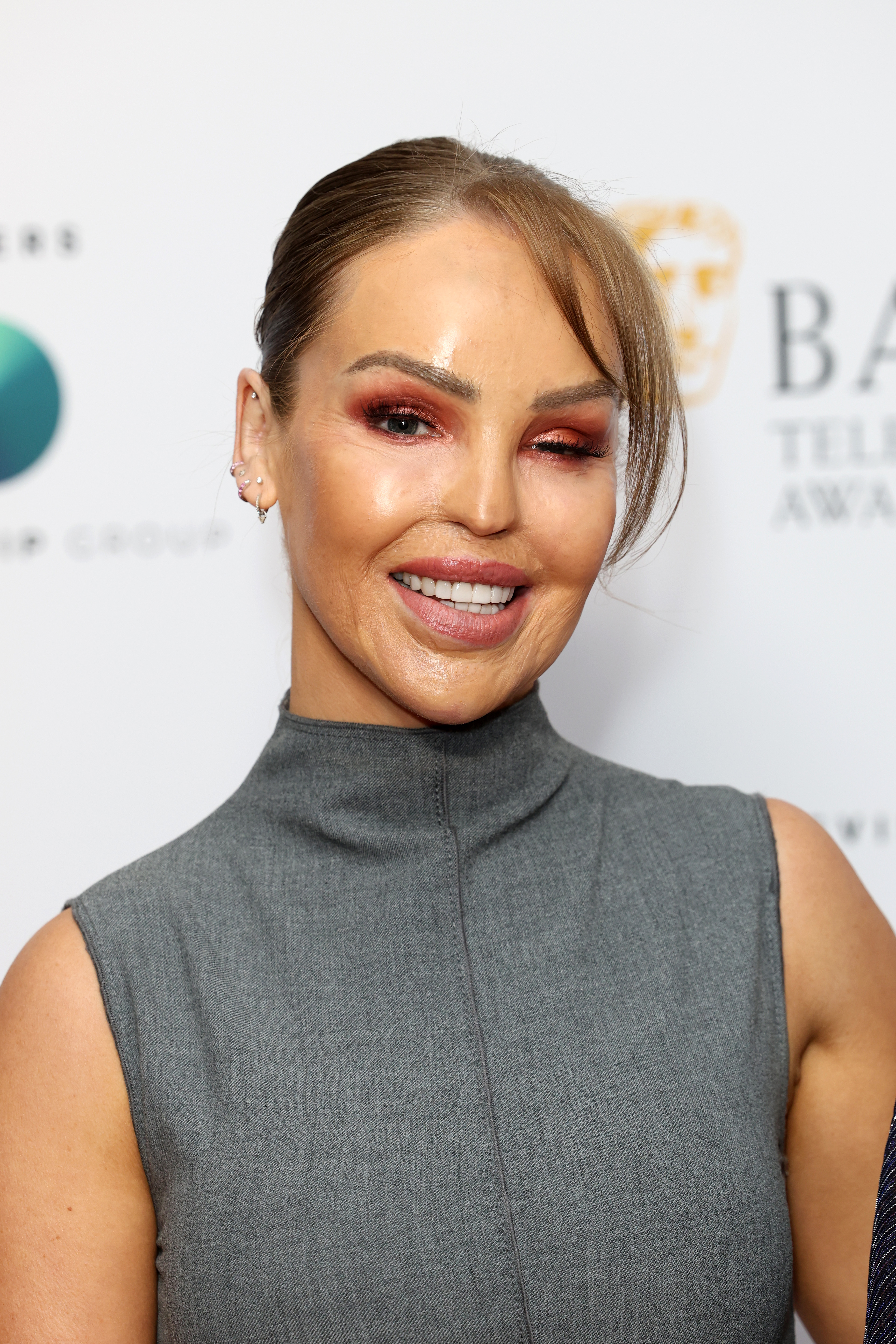 Katie Piper a laissé des cicatrices permanentes à la suite de l'attaque