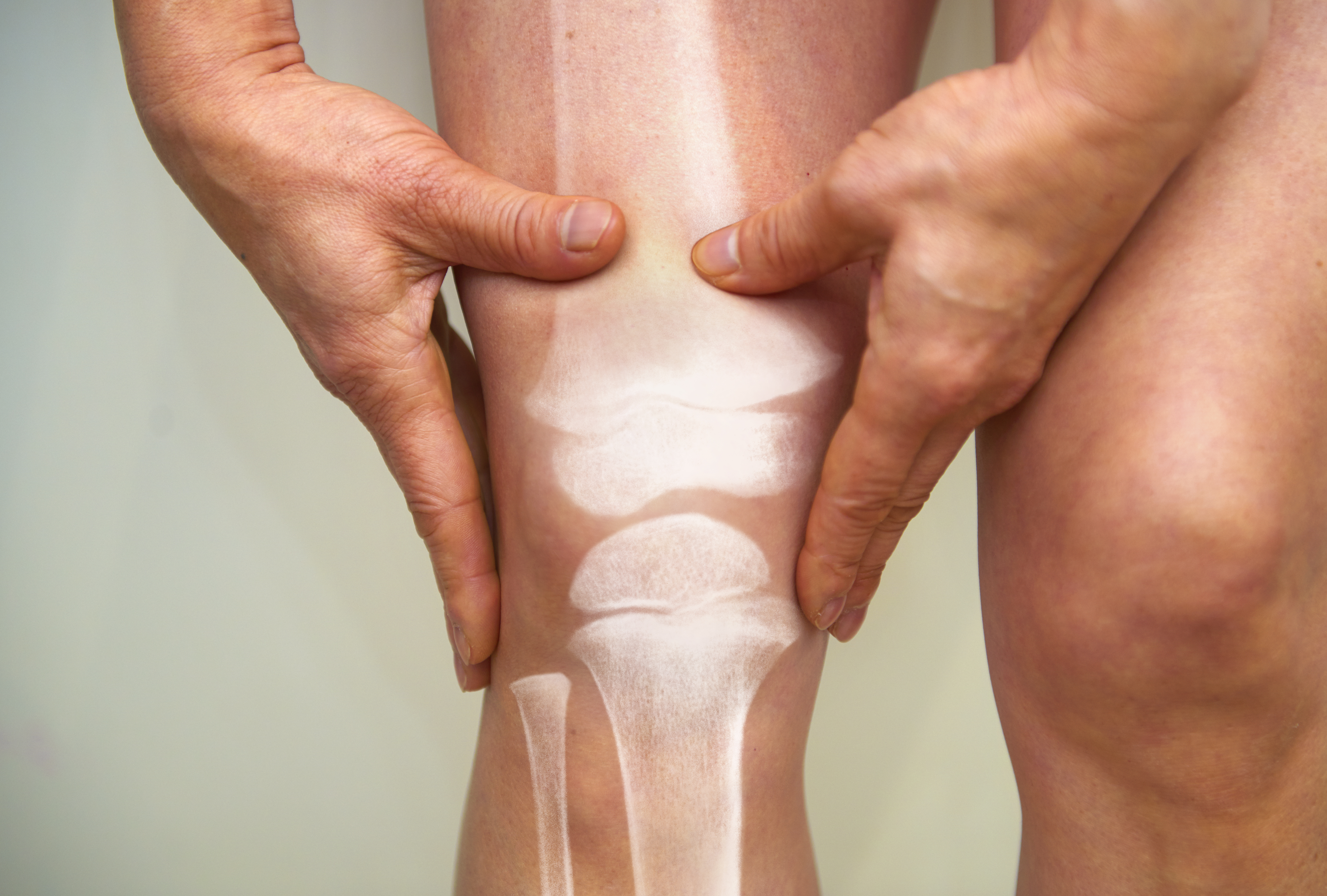 L'arthrose est une maladie articulaire qui survient lorsque le cartilage qui amortit les extrémités des os s'use avec le temps.