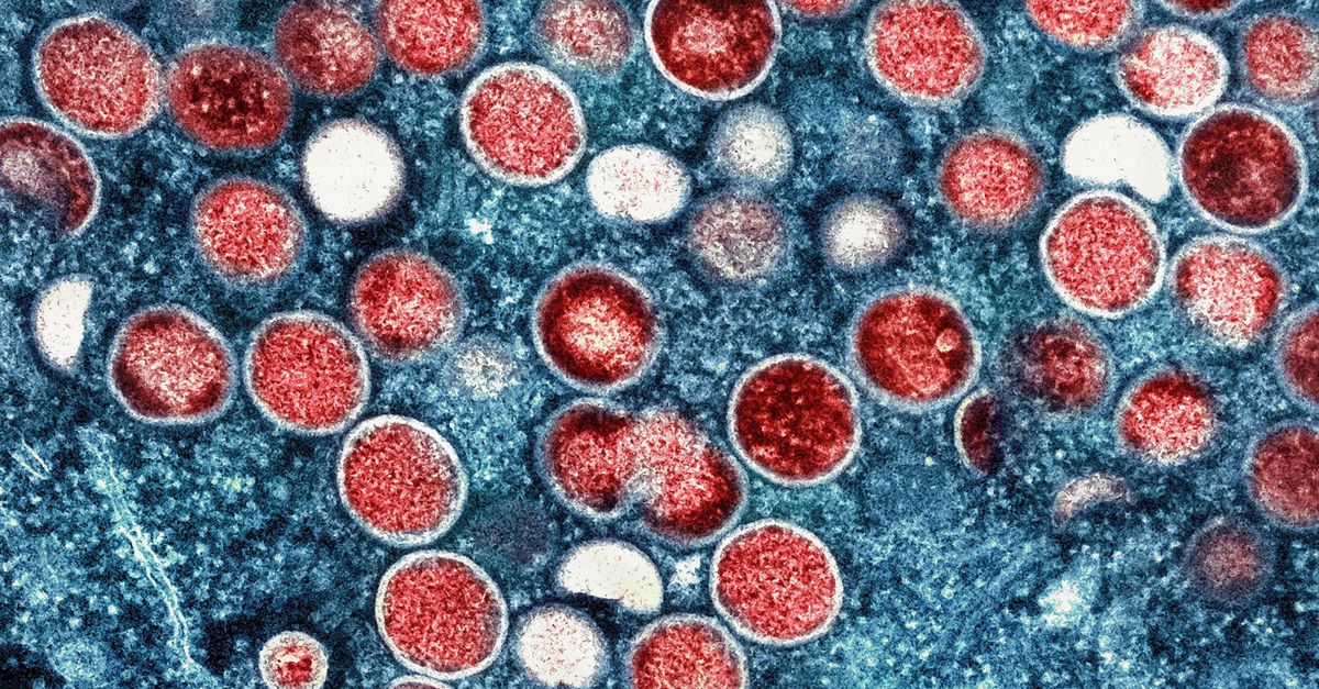 Plus contagieuse, plus mortelle et désormais repérée en Suède : que sait-on de la nouvelle souche mpox ?