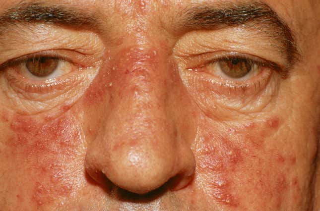 Bir rosacea örneği. 